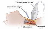 Пункция патологического образования под контролем УЗИ