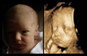 УЗИ при беременности II-III  триместр (13 недель – 40 недель) 