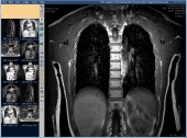 Магнитно-резонансная томография грудного отдела позвоночника