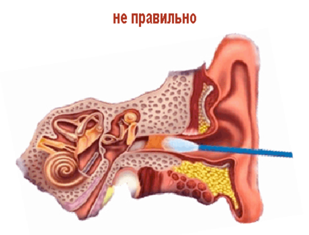 Почему возникает пробка в ухе. Ушная серная пробка симптомы. Правосторонний тубоотит.