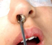 Удаление инородного тела из носа