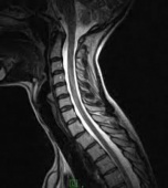 Магнитно-резонансная томография  шейного отдела позвоночника и артерий шеи