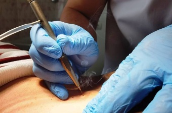 Диатермоэлектрокоагуляция или криодеструкция множественных новообразований (до 5-ти)